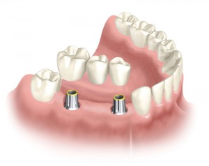 Dental Implant Screw