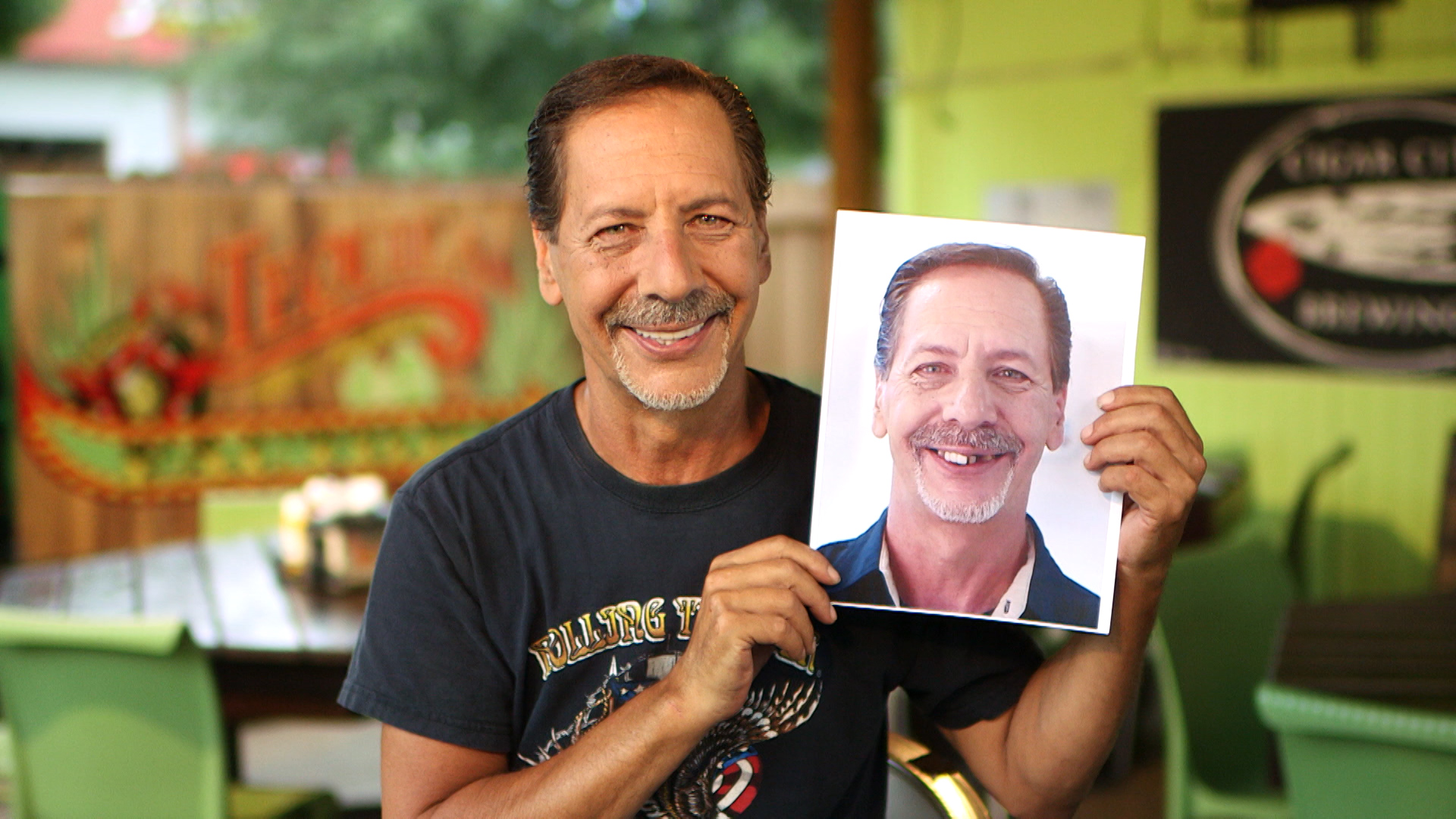 Dental Implants Patient Bruce