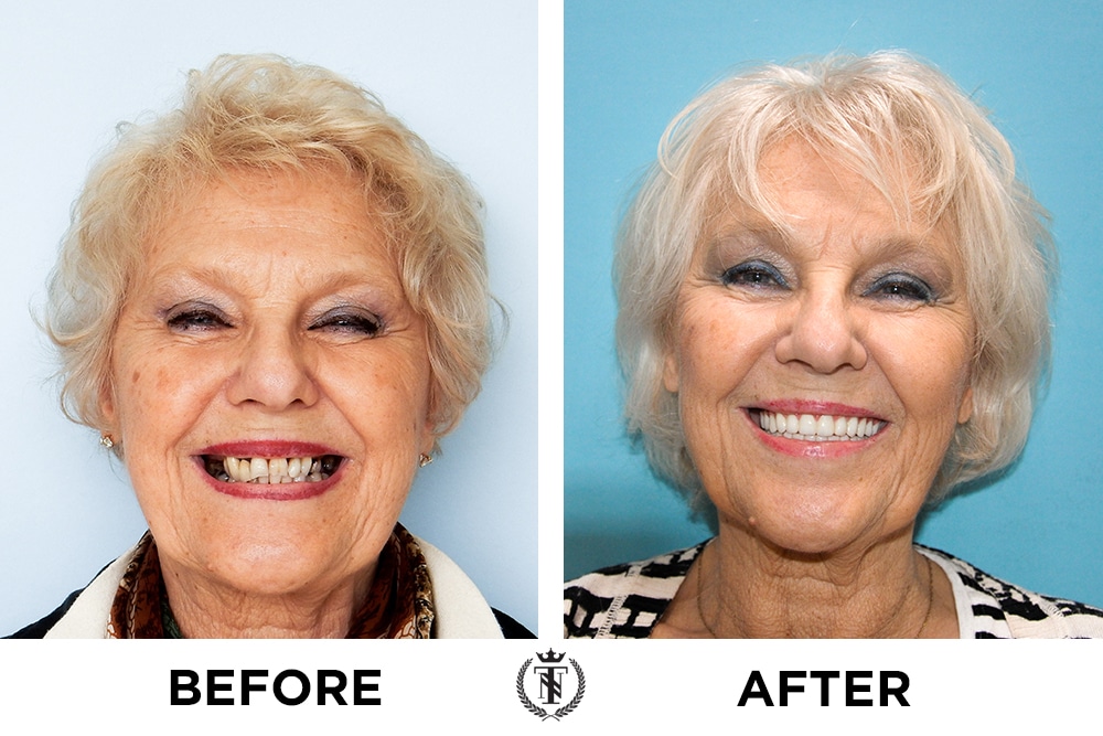 patient with affordable multiple dental implants patient shows off her new smile, before and after photos