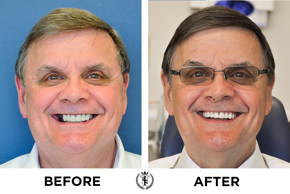 front tooth and anterior before and after dental implants