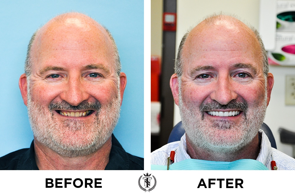Matt Schillinger with full arch titanium dental implants before and after photos
