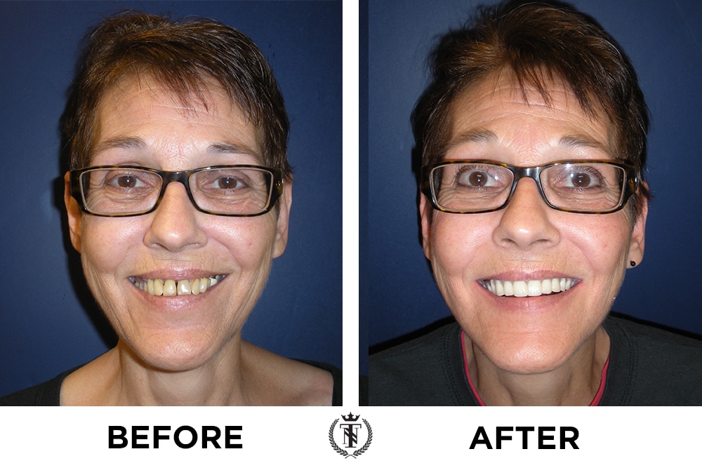 Barbara Henry full dental implants all on 4 before and after photo