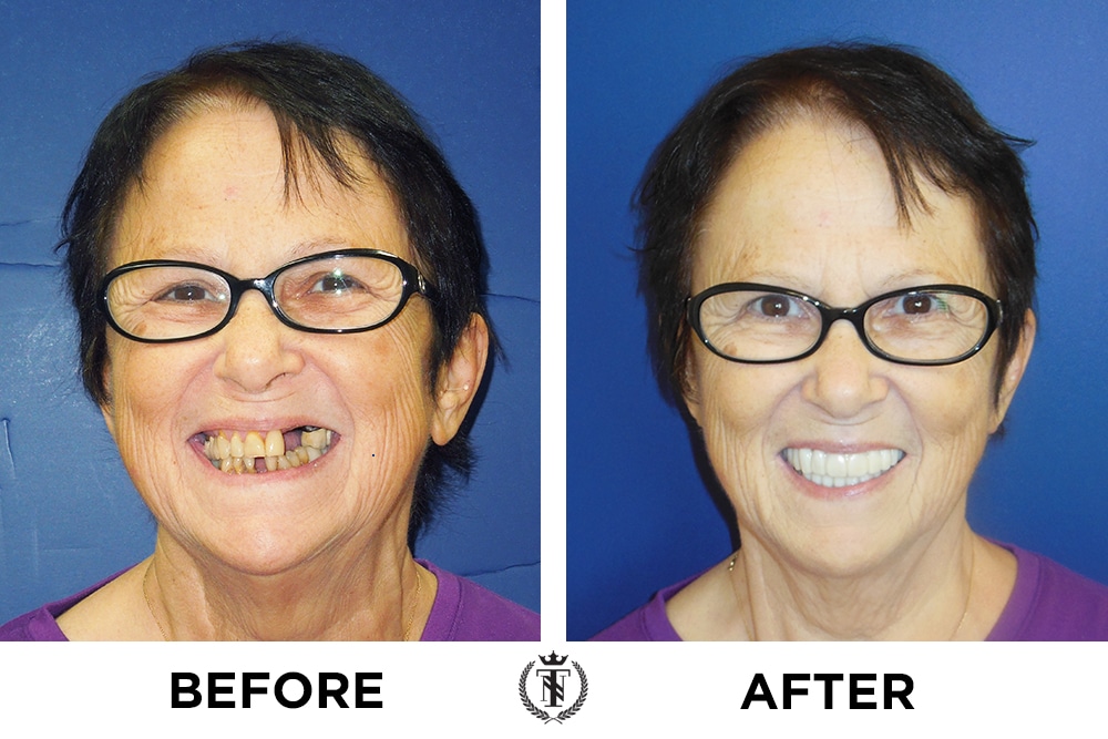 Lorraine Hanafin full mouth restoration before and after huge smile
