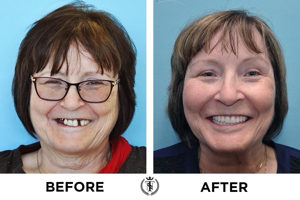Katherine Stallard hybrid dental implants patient before and after photos