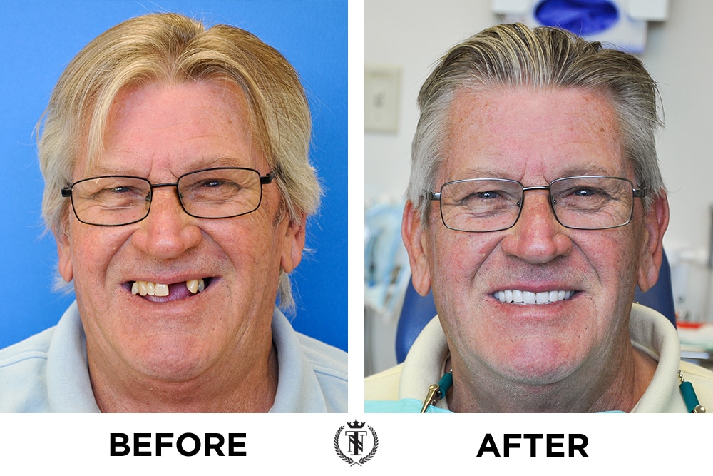 Multiple dental implants recipient before and after photos