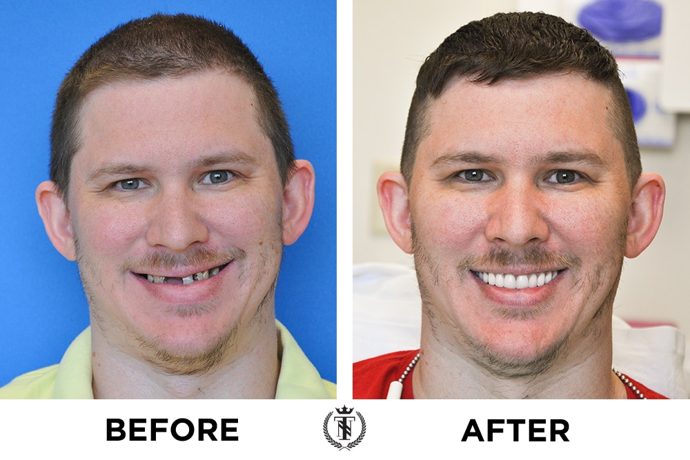Partial dental implants patient before and after for upper implants