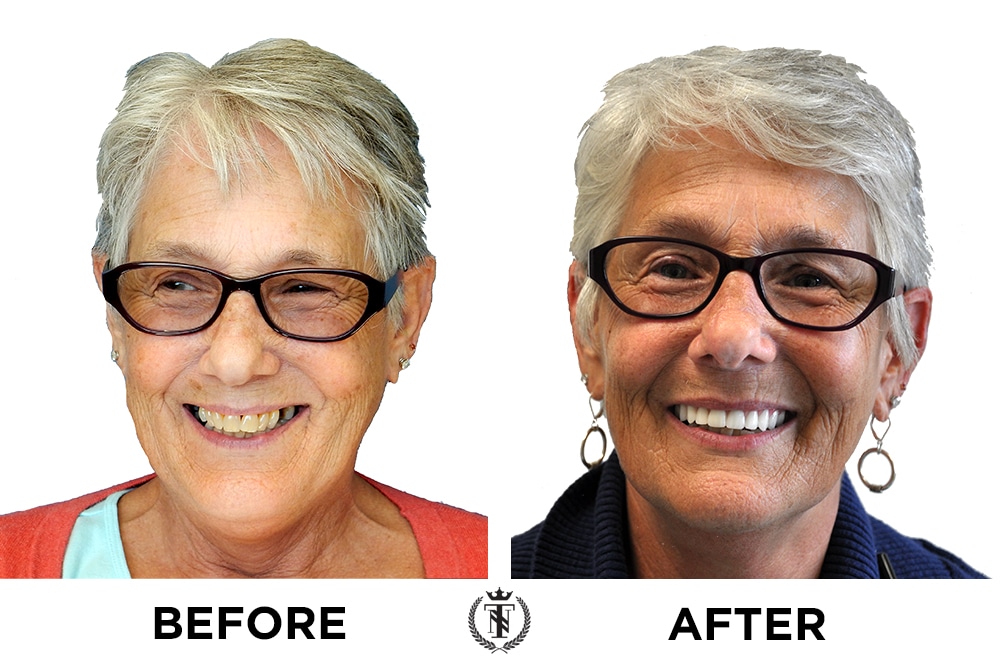 Smiling patient Kathleen Albert with dental implants before and after photo