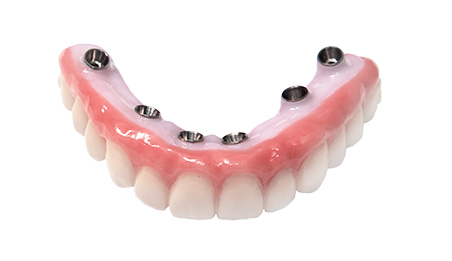 all on 4 upper arch dental implants