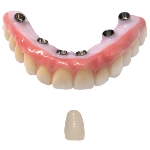 Циркониевая верхняя дуга и один зуб