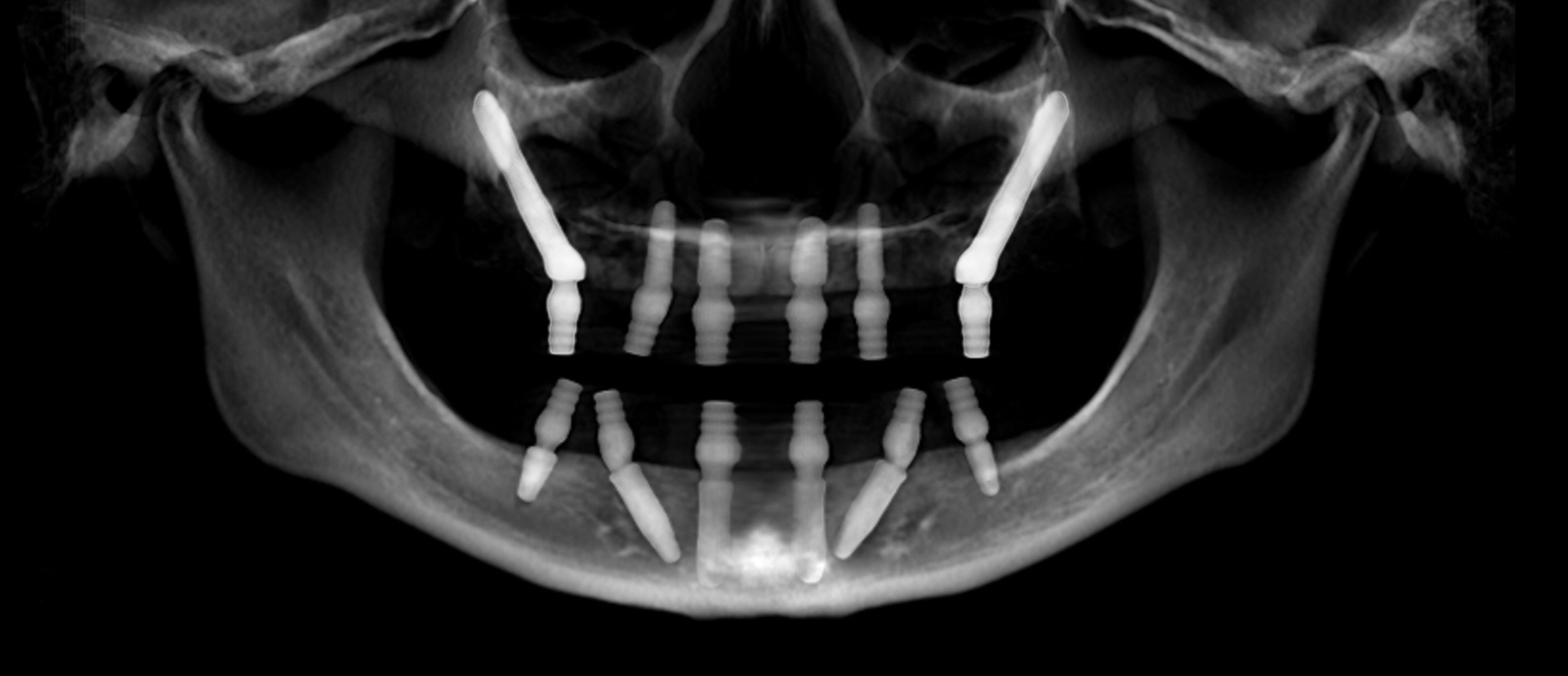zygomatic implants highlighting the reach of the longer implants into the zygoma