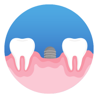 single tooth multiple implants