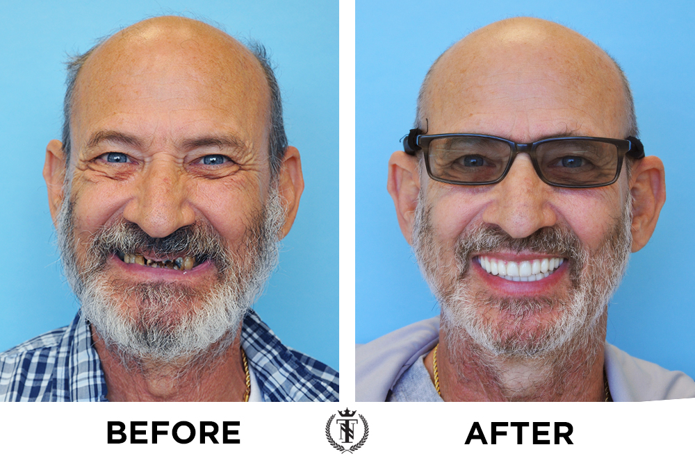 dental implants patient life transformation before and after photo of older gentleman