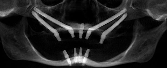 Quad zygomatic implants x-ray, four long zygomatic implants shown reaching into the zygoma or cheekbones