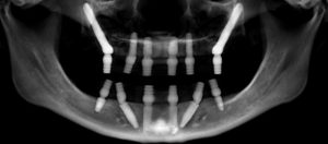 zygomatic implants no bone grafting xray