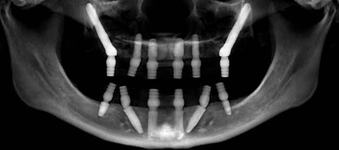 X-ray of All-On-Six with two zygomatic implants, no bone grafting and two angled abutments in the lower jaw