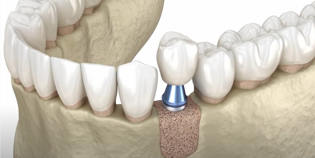 3D illustration of single tooth dental implant abutment with crown set in jaw bone