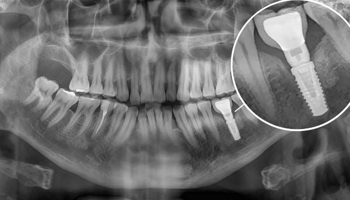 x-ray of a dental implant in the lower jaw