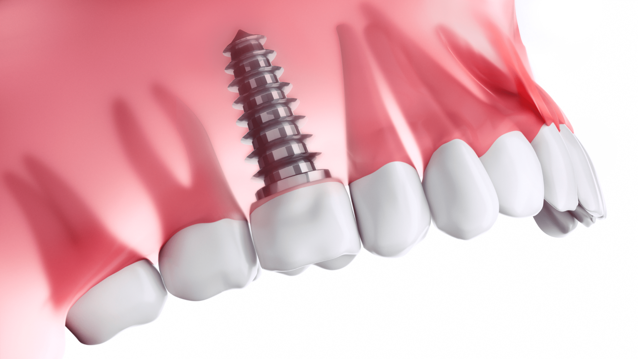 Cross section of implant in upper jaw