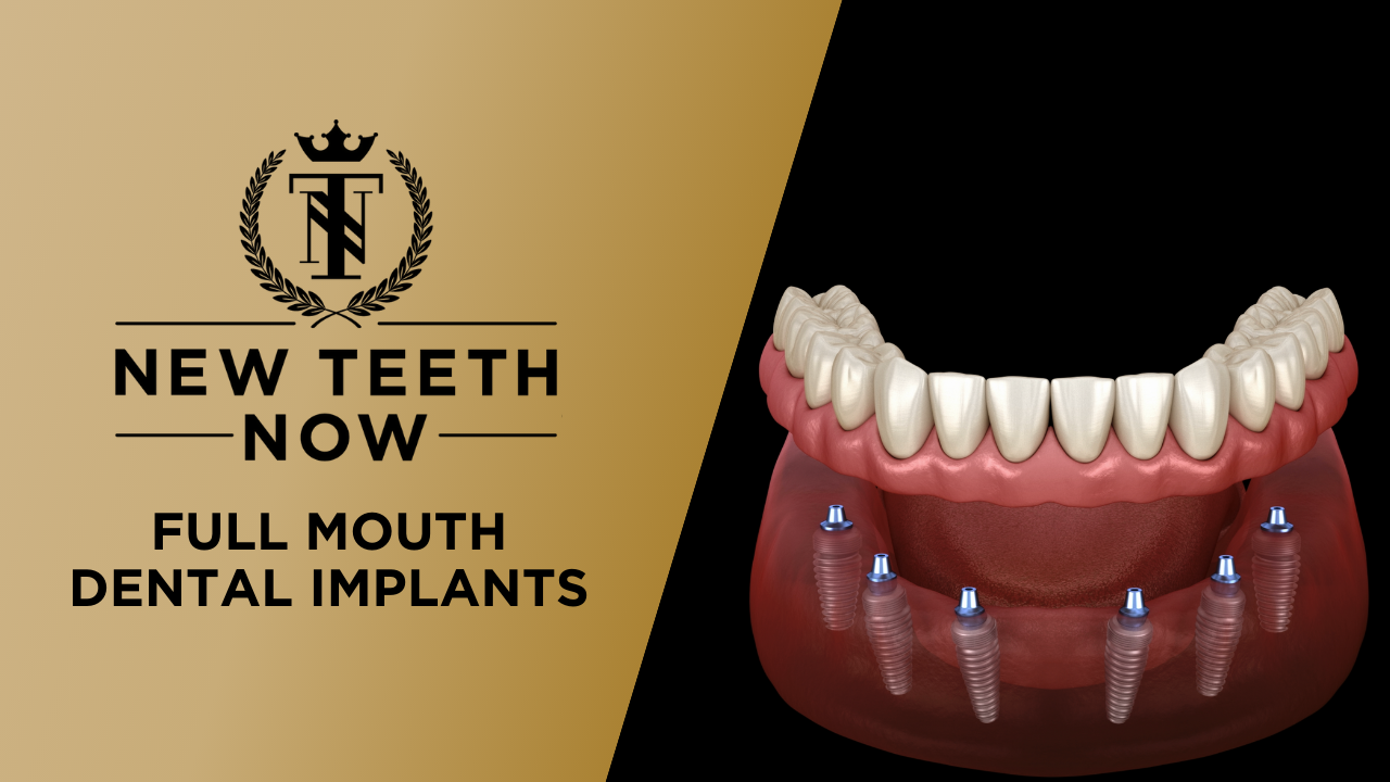 all-on-4® full mouth dental implants