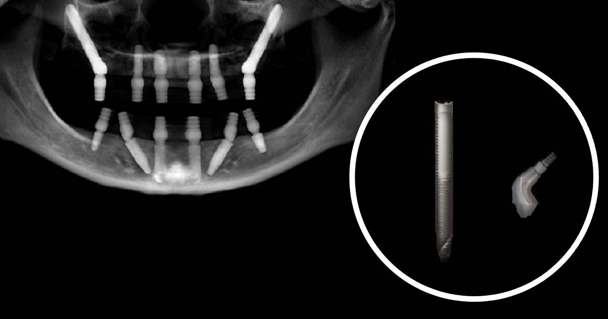 Zygomatic Dental Implants for Severe Bone Loss