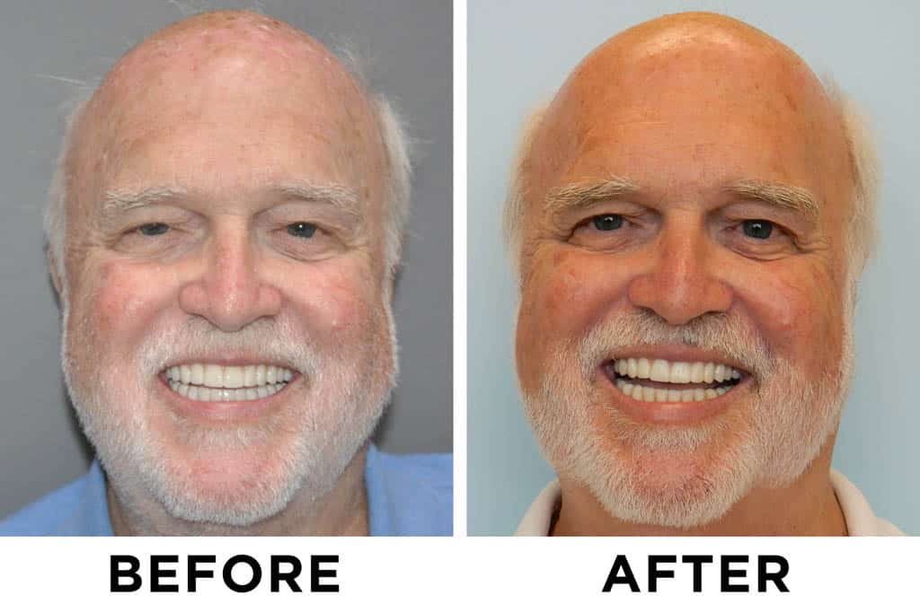 new teeth now patient 26