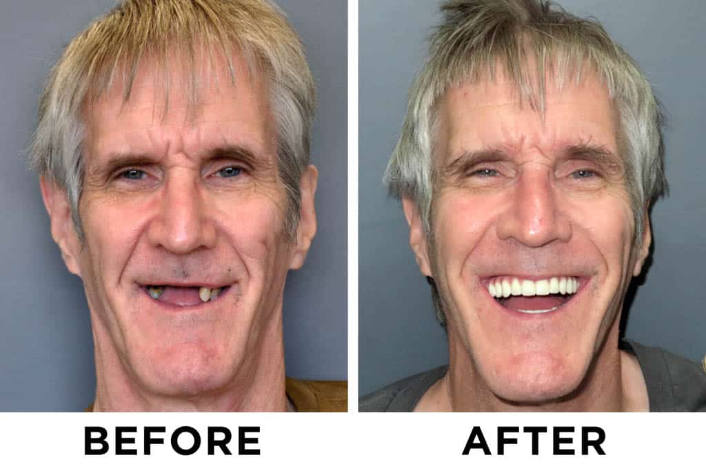 new teeth now patient 72