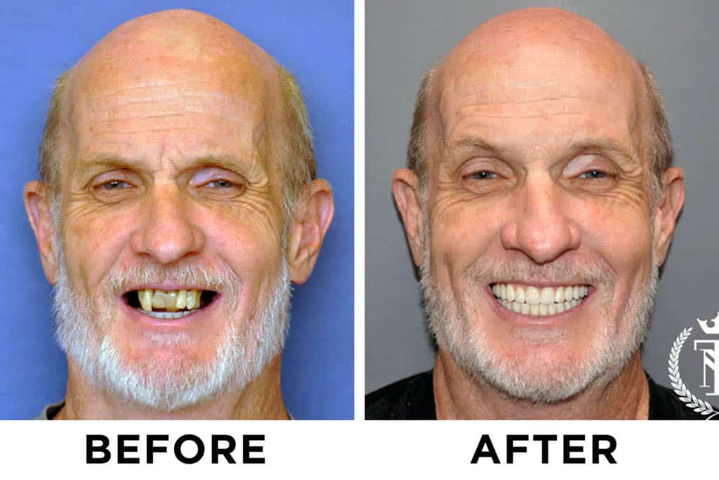 new teeth now patient 75