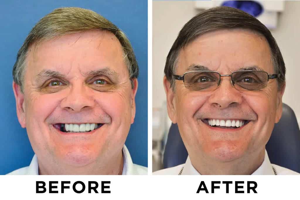 new teeth now patient 83