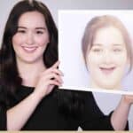 Dental Implants Without Bone Grafting: How Zygomatic Implants Restore Smiles With Severe Bone Loss