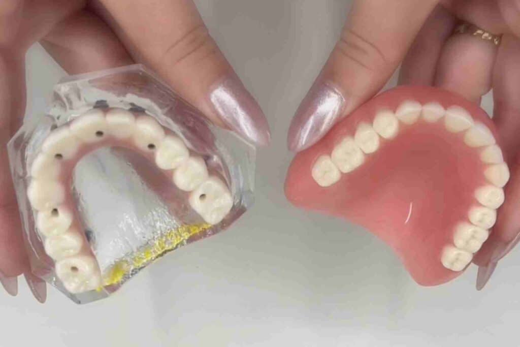 side by side of dental implants and dentures showing palate coverage