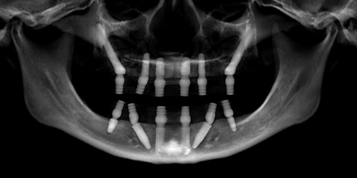 Zygomatic Dental Implants Jaw X-ray and Implant Length