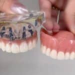 The Highest-Quality Alternative to Dentures