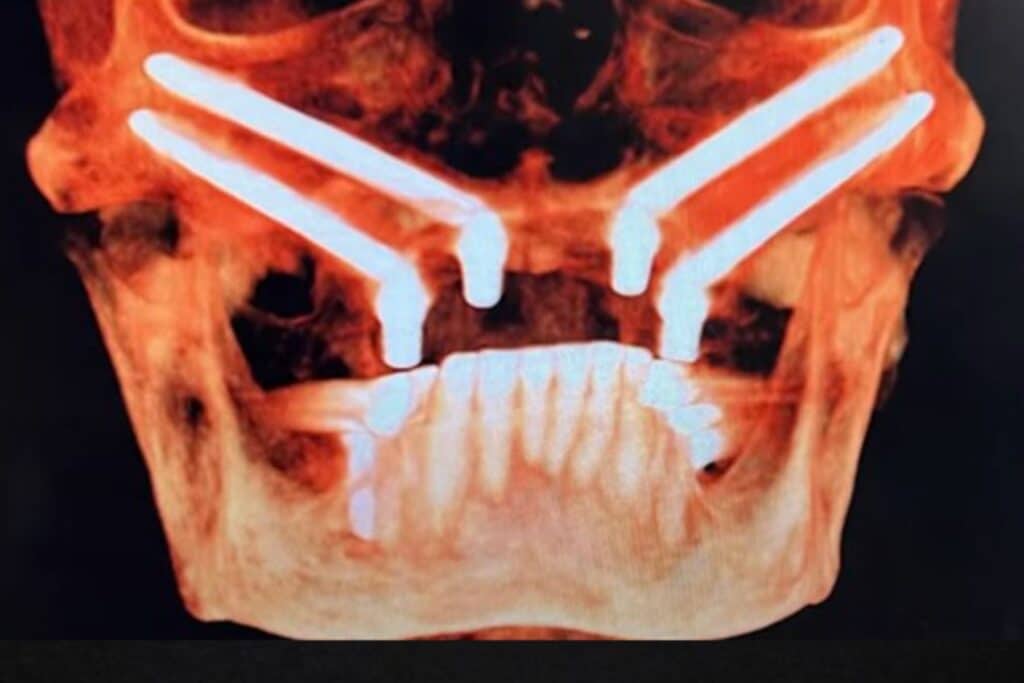 quad zygomatic implants for extreme bone loss