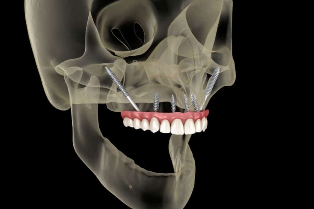 zygomatic implant diagram