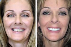 Before and after new teeth now patient with periodontal disease