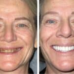 Gum Disease Awareness & Dental Implants | New Teeth Now