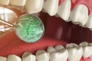 gum disease in the mouth