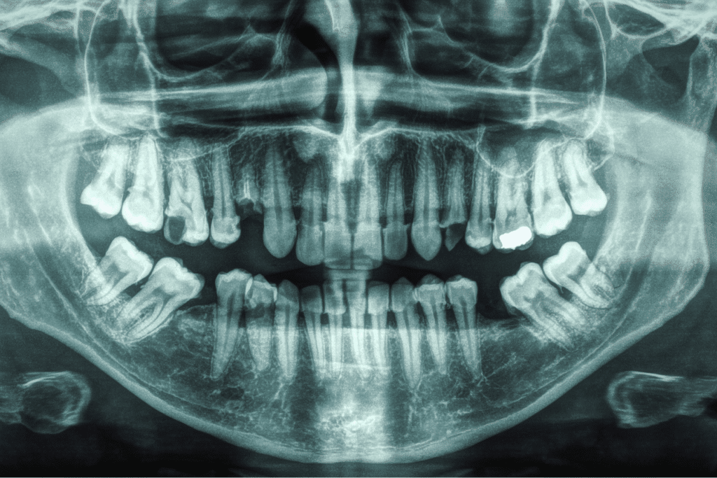bone loss in a full set of teeth