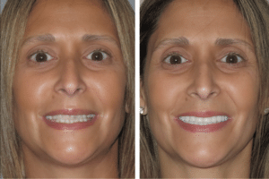 before and after new teeth now