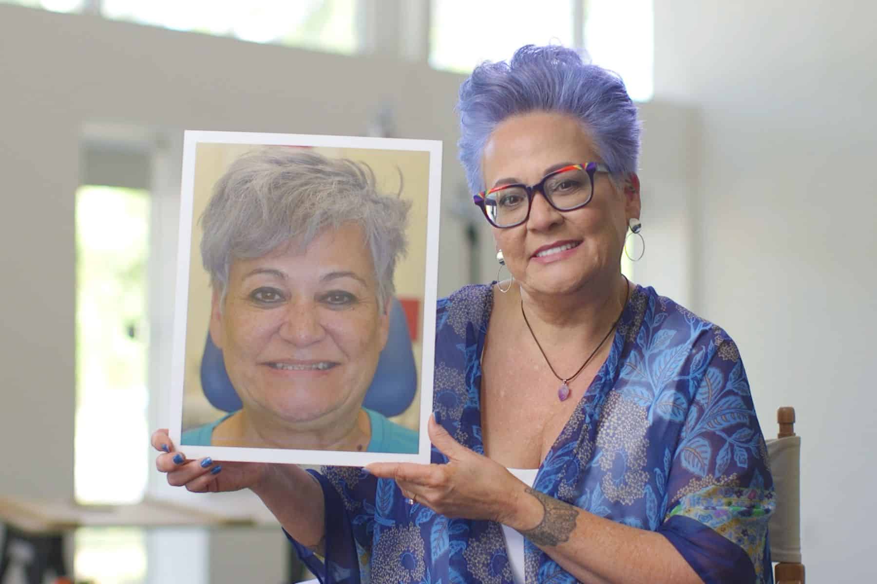 before and after dental implants