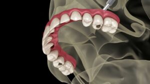 zygomatic implants