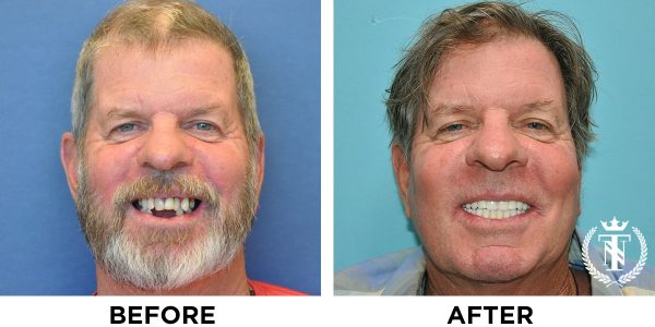 Bill before and after dental implants after healing from gum disease