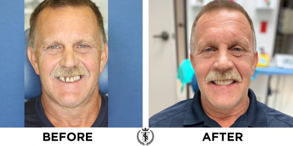 Glenn middle aged bone loss periodontal disease patient showing off his new smile
