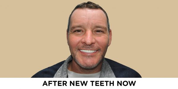 periodontitis treatment jeremy's after procedure photo with New Teeth Now