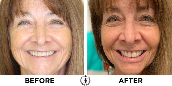 before and after of Kathy showing results of advanced gingivitis treatment