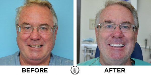 periodontal disease treatment for William before and after photo